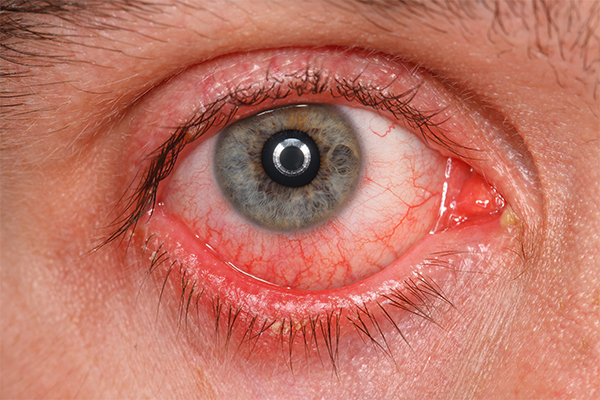 Gerötete und gereizte Augen – Homöopathie bei Bindehautentzündung und Co.